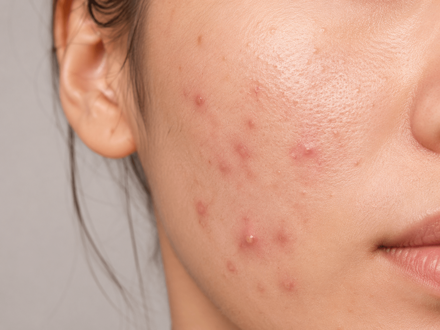 what is acne skincare guide